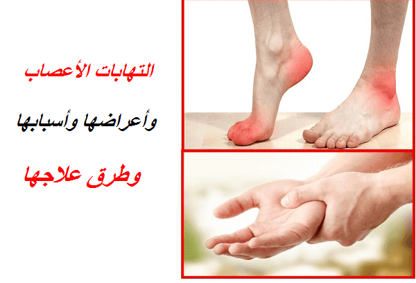 إليك كل ما تحتاج لمعرفته حول أعراض وأسباب وعلاج التهاب العصب مدونة Health Wonders