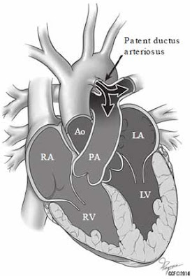 Patent ductus arteriosus