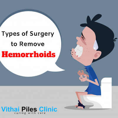 surgery for hemorrhoids, hemorrhoids, internal hemorrhoids, external hemorrhoids, Rubber Band Ligation, Hemorrhoidectomy,