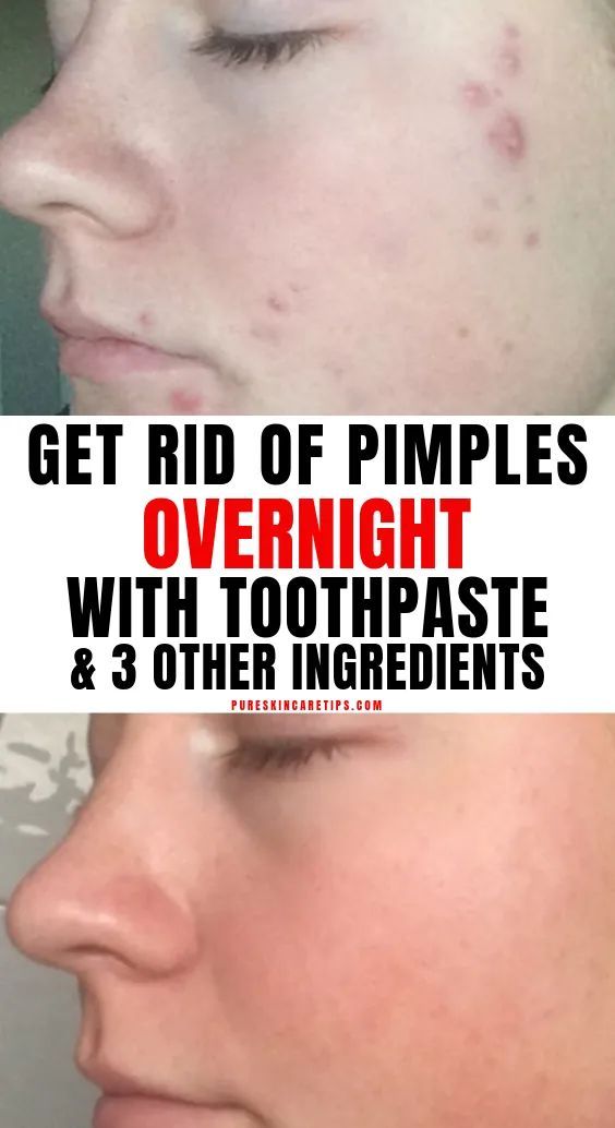 Get Rid Of Pimples Overnight With Toothpaste & 3 Other Ingredients