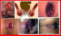 Obat Herbal untuk Ambeien Parah yang Ada di Sekitar Kita