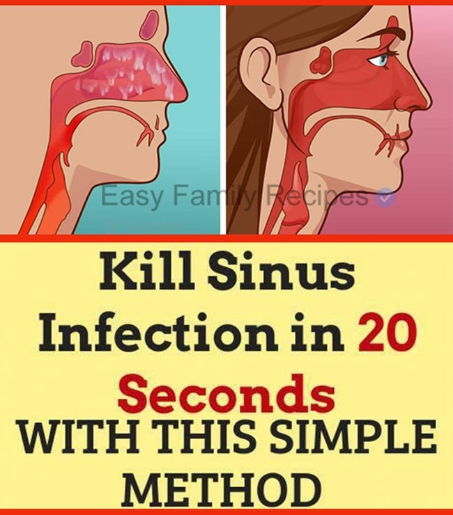 Kill Sinus Infection in 20 Seconds With This Simple Technique