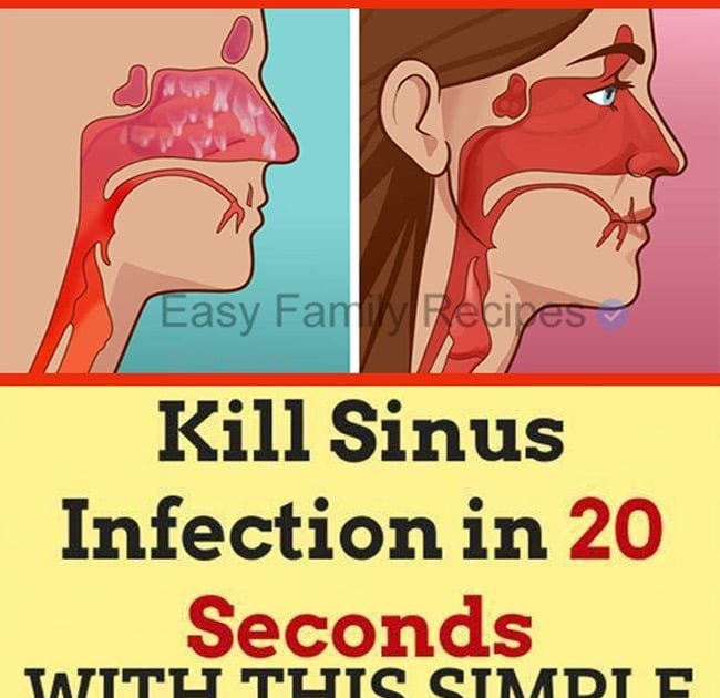 Kill Sinus Infection in 20 Seconds With This Simple Technique