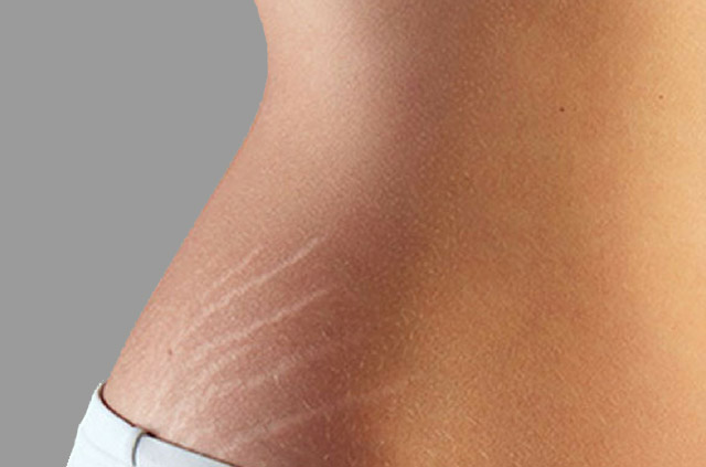These home remedies will get rid of the stretch marks on the body, you just have to do it These home remedies will get rid of the stretch marks on the body, you just have to do it