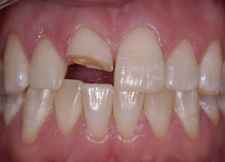 Phục hình răng bị gãy một nửa hoàn hảo bằng trồng răng implant