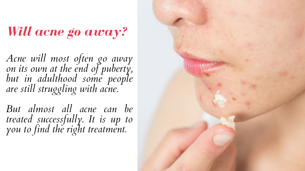 Teenage-acne-diet-what-is-the-best-method-to-use-for-teenage-acne-2020