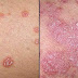 Psoriasis : maladie de peau chronique, symptômes, traitements
