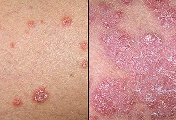 Psoriasis : maladie de peau chronique, symptômes, traitements