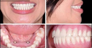 غير مسلح وحدة التقط صوره اطقم الاسنان المتحركة Novisadapartman Com