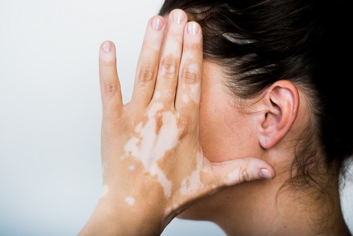 Learn all the ways to treat white spots at home