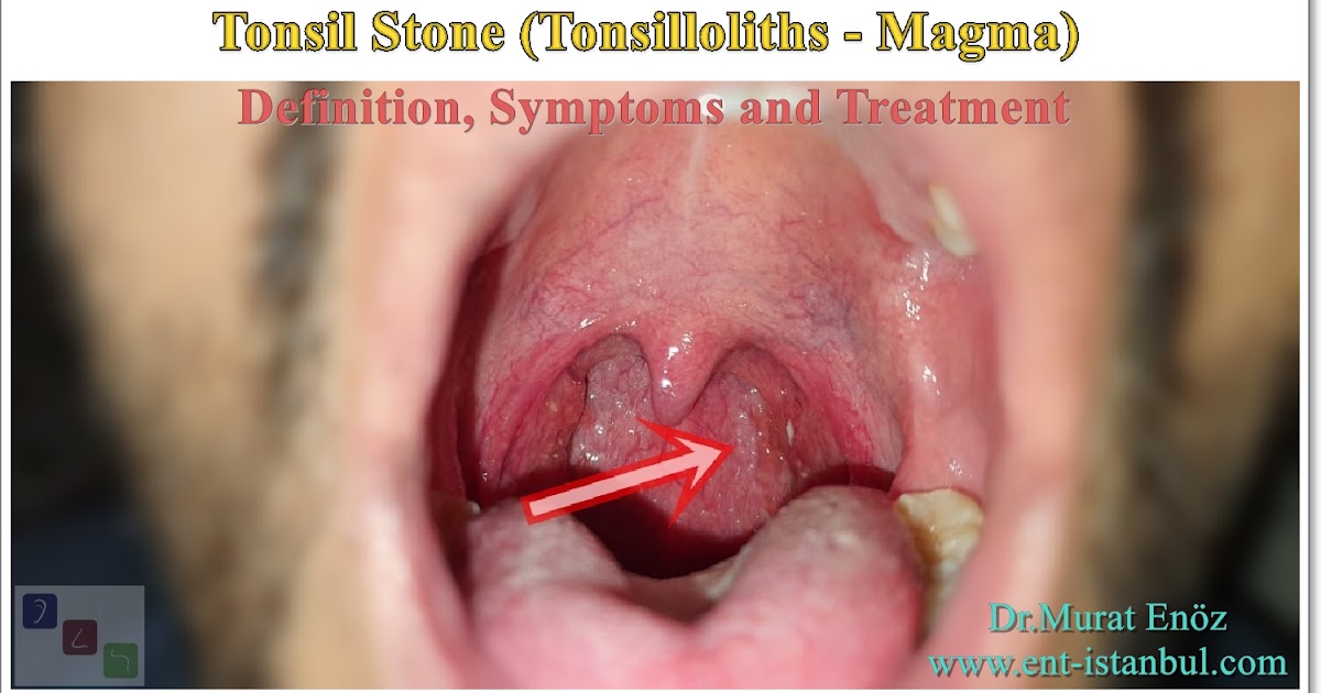 Pot tonsil stones