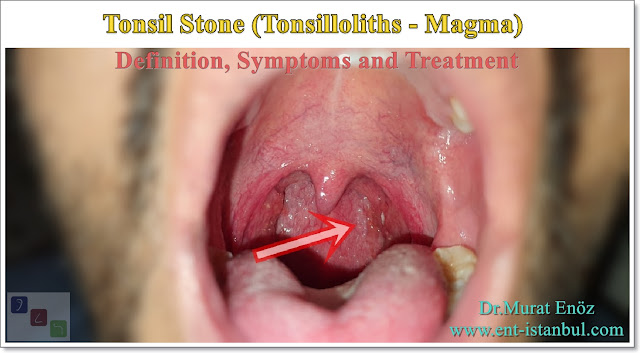 What is a tonsil stone? - Causes tonsil stones? - What are the symptoms of tonsil stones? - Who gets tonsil stones? - What kind of problems can tonsil stones cause? - How to treat tonsil stones? - How to clean tonsil stones? - How is tonsil stone surgery performed?