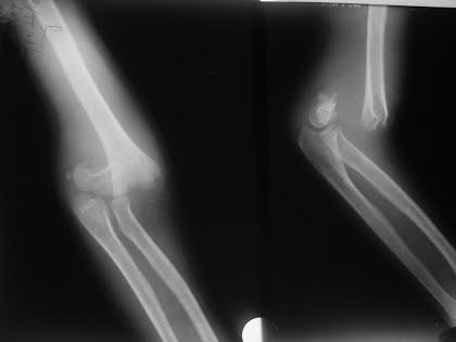 O R T O C R I T I C A: CODO PEDIATRICO COMPLICADO