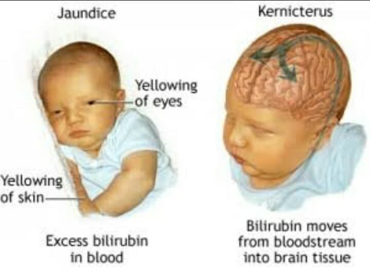 ANO BA ANG G6PD (Glucose6 Phosphate Dehydrogenase)