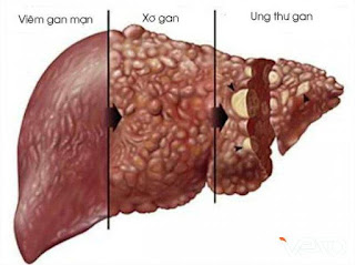 Slide bài giảng viêm gan mạn