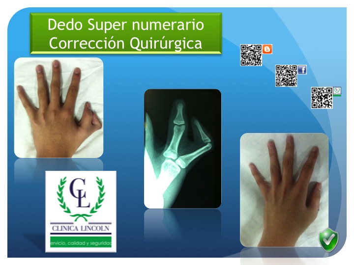 Cl nica Lincoln Dedo Supernumerario Correcci n Quir rgica