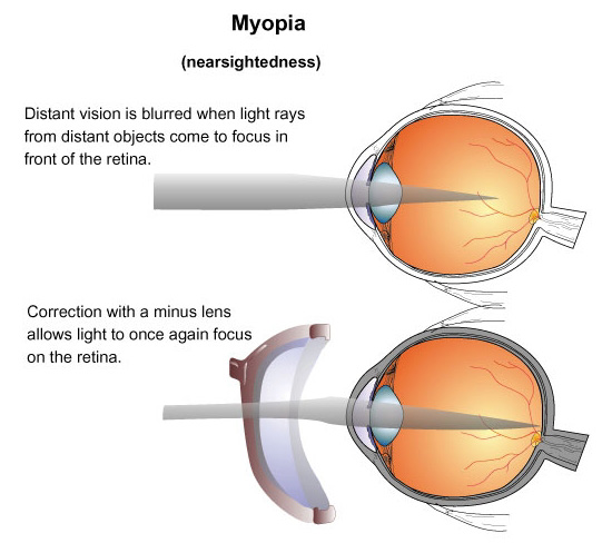 astigmatism myopia simplex adalah