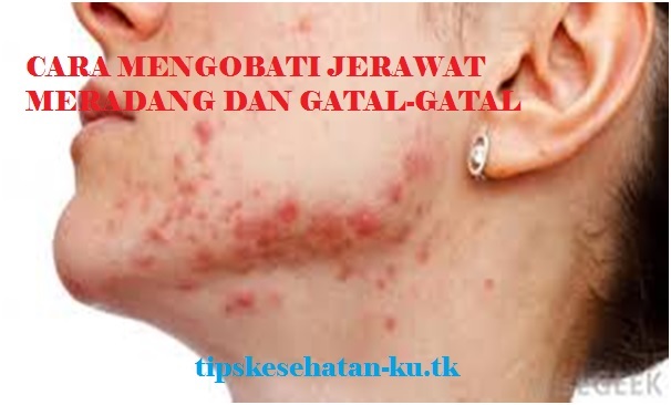 cara mengobati jerawat meradang dan gatal-gatal secara alami