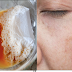 In 2 Days - Remove Dark Spots, Black Spots At Acne Scars Using These Natural Remedies