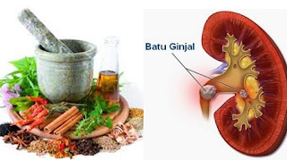 PENYEBAB DAN TIPS PENCEGAHAN PENYAKIT BATU GINJAL SECARA ALAMI