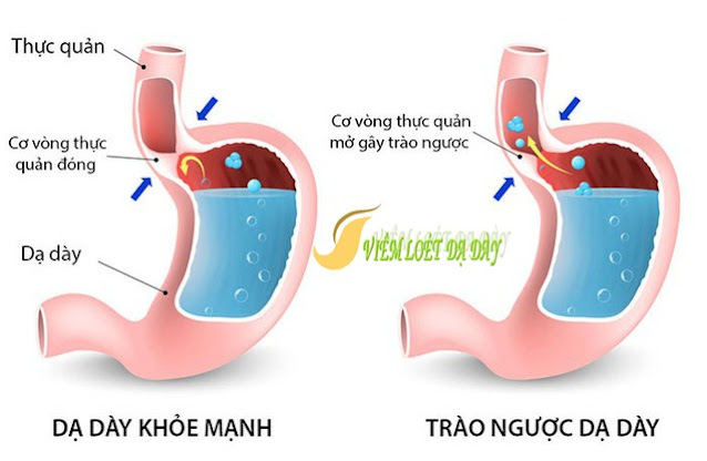 cac benh ly thuong gap o da day can biet các bệnh lý thường gặp ở dạ dày cần biết