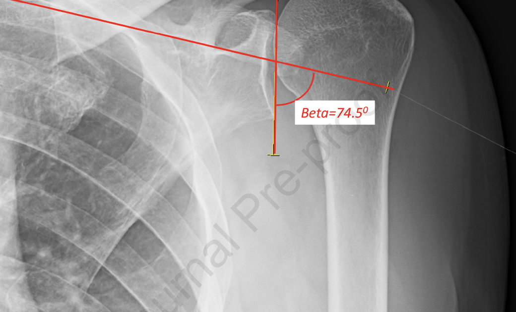 Shoulder Arthritis / Rotator Cuff Tears: causes of shoulder pain