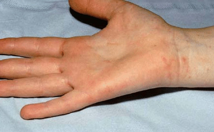 Hand Rash - Symptoms, Causes, Treatments - Healthgrades