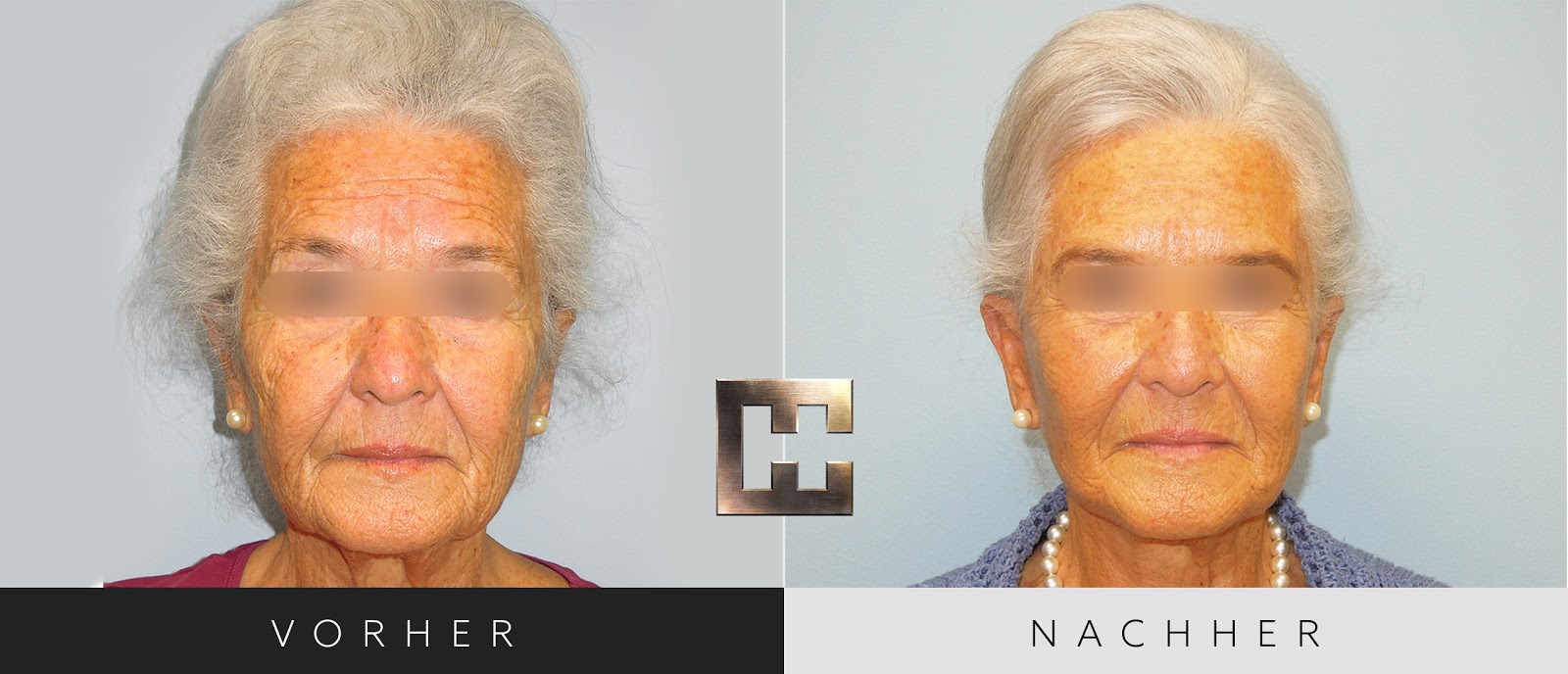 geschlechtsumwandlung genitalien vorher nachher woodenbild )