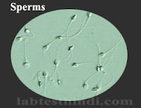 Urine Microscopic - Sperm