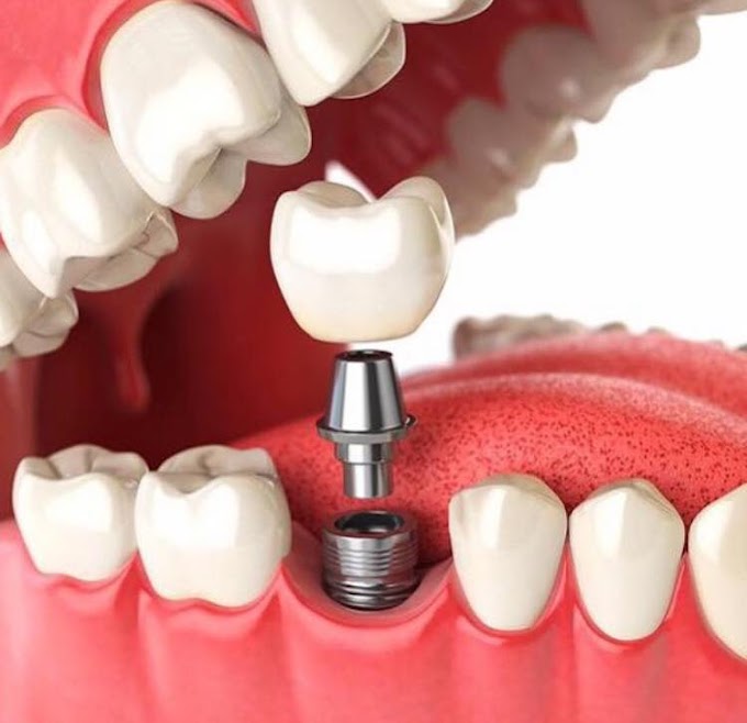 La importancia de reemplazar los dientes que se caen (Odontología)