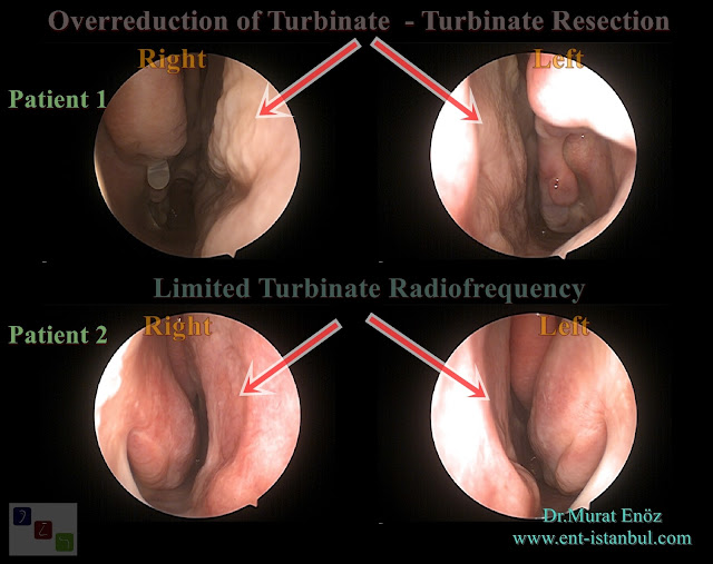Overreduction of Turbinate,Turbinate Resection,Nasal Hyperventilation,Limited Turbinate Radifrequency,Normal turbinate volume, Sensation of being unable to breathe