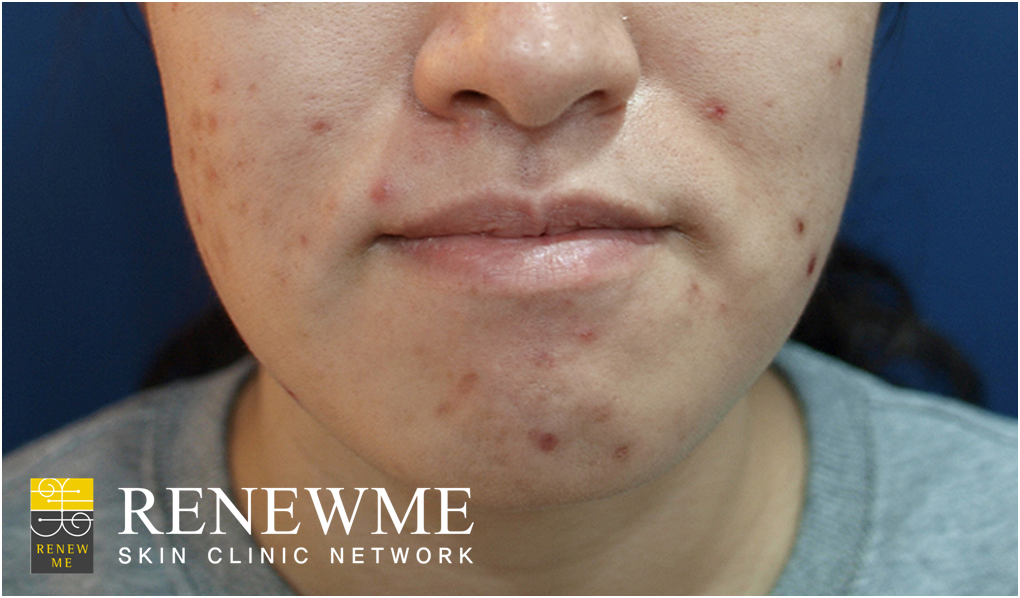 Renewme Skin Clinic Excel V Laser for Acne Marks