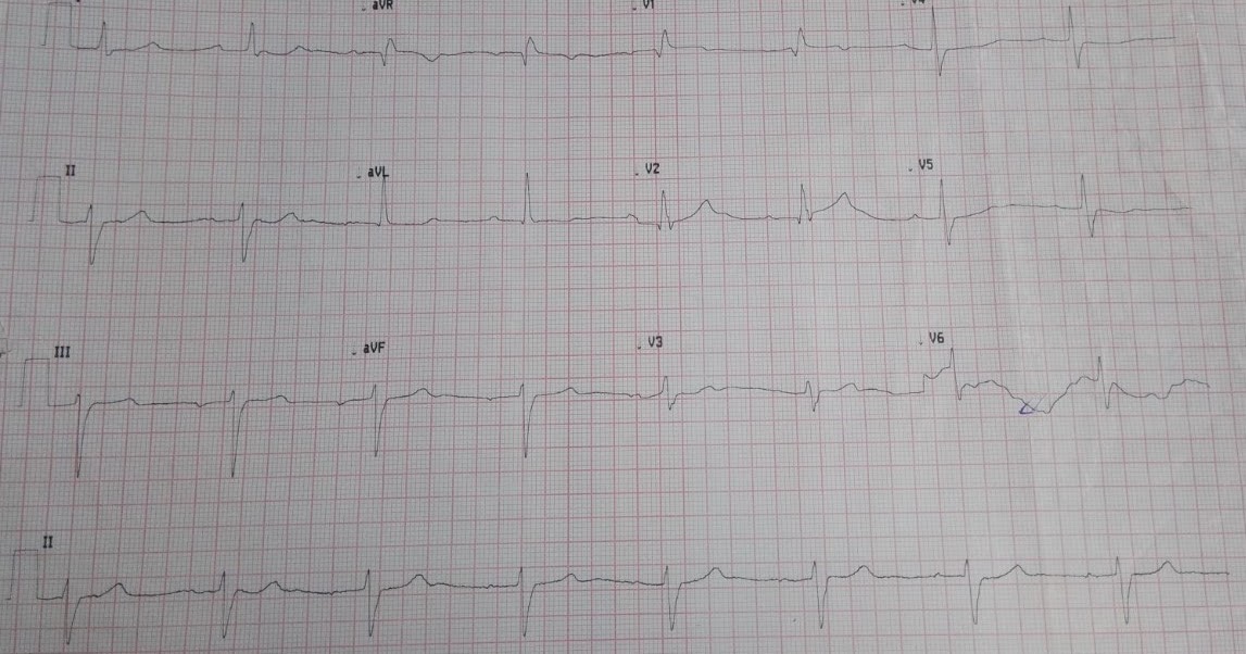 Cardiology window Trifascicular block with sinus bradycardia