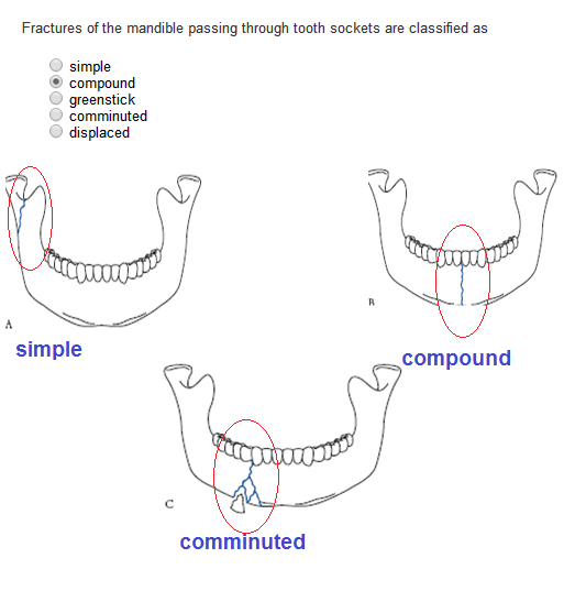 The Classification Of Mandibular Condyle Fracture Acc - vrogue.co