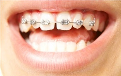 Ưu điểm của niềng răng sứ là gì?