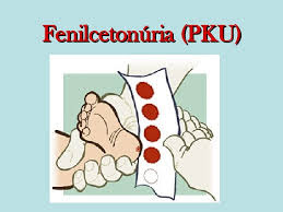 Fenilcetonuria – PKU