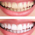 Tẩy trắng răng bằng laser giá bao nhiêu?