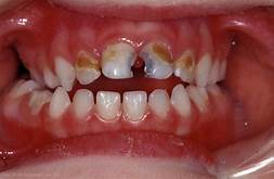 caries gigi atau biasa di sebut dengan lubang pada gigi yang biasanya berwarna hitam.