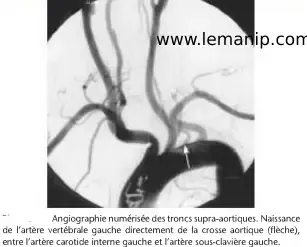 Pendant Et Après l'examen De L'angiographie Cérébrale