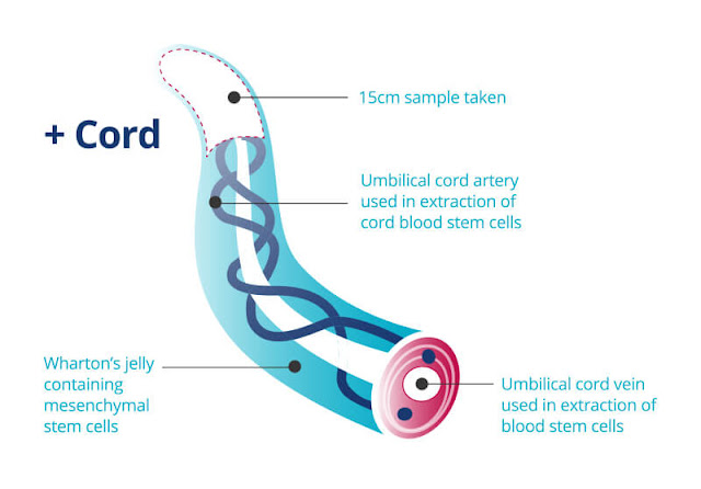 Umbilical Cord Blood to Extract Stem Cells,umbilical cord blood,umbilical cord blood banking,umbilical cord bloodborne,umbilical cord blood vessels,umbilical cord blood stem cells,umbilical cord blood transplant,umbilical cord blood flow,umbilical cord blood collection,umbilical cord blood sampling,umbilical cord blood analysis,umbilical cord blood as a source of stem cells,umbilical cord blood autism,umbilical cord blood acid-base analysis at delivery,umbilical cord blood after falling off,umbilical cord blood and tissue banking,umbilical cord blood and type 1 diabetes,umbilical cord blood acid-base analysis,umbilical cord blood banking cost,umbilical cord blood banking in india,umbilical cord blood banking uk,umbilical cord blood blister,umbilical cord blood banking slideshare,umbilical cord blood banking canada,umbilical cord blood banking price,umbilical cord blood cells,umbilical cord blood clot,umbilical cord blood collection kit,umbilical cord blood circulation,umbilical cord blood collection procedure,umbilical cord blood cerebral palsy,umbilical cord blood cost,umbilical cord blood definition,umbilical cord blood donation uk,umbilical cord blood donation public or private,umbilical cord blood donation risks,umbilical cord blood drug testing,umbilical cord blood donations,umbilical cord blood draw,umbilical cord blood derived mesenchymal stem cells,umbilical cord blood ethical issues,umbilical cord blood exosomes,umbilical cord blood extraction,umbilical cord blood embryonic stem cell,umbilical cord blood explained,umbilical cord blood examples,umbilical cord blood endocrine disruptors,umbilical cord blood erythrocytes,umbilical cord blood flow ultrasound,umbilical cord blood flow problems,umbilical cord blood flow resistance,umbilical cord blood for bone marrow transplant,umbilical cord blood flow high,umbilical cord blood flow restriction,umbilical cord blood for autism,umbilical cord blood gas,umbilical cord blood gases,umbilical cord blood gas analysis,umbilical cord blood gas interpretation,umbilical cord blood gas values,umbilical cord blood gasses,umbilical cord blood gas reference ranges,umbilical cord blood gas normal values,umbilical cord blood harvesting,umbilical cord blood hemoglobin,umbilical cord blood hematopoietic stem cells,umbilical cord blood hla matching,umbilical cord blood hair,umbilical cord blood hormones,umbilical cord blood haematopoietic stem,umbilical cord blood how to donate,umbilical cord blood is rich in stem cells,umbilical cord blood information for childbirth educators,umbilical cord blood injection,umbilical cord blood immunoglobulin,umbilical cord blood infant,umbilical cord blood isolation,umbilical cord blood important,umbilical cord blood in hindi,umbilical cord blood collection jobs,umbilical cord blood jelentése,umbilical cord blood kit,umbilical cord blood natural killer cells,keeping umbilical cord blood,keep umbilical cord blood,should i keep umbilical cord blood,benefits of keeping umbilical cord blood,knowledge and attitudes umbilical cord blood,umbilical cord blood leukemia treatment,umbilical cord blood lifespan,umbilical cord blood location,umbilical cord blood leptin,umbilical cord blood life,umbilical cord blood labs,umbilical cord blood legal,umbilical cord little blood,umbilical cord blood mononuclear cells,umbilical cord blood meaning,umbilical cord blood mesenchymal stem cells,umbilical cord blood msc,umbilical cord blood meaning in hindi,umbilical cord blood multiple sclerosis,umbilical cord blood mesenchymal stem cells flow cytometry,umbilical cord blood mayo clinic,umbilical cord blood newborn,umbilical cord blood nhs,umbilical cord blood nk cells,umbilical cord blood normal range,umbilical cord blood name,umbilical cord blood nucleated cells,newborn umbilical cord blood,umbilical cord blood on clothes,umbilical cord blood overview,umbilical cord blood of neonates,umbilical cord blood of,umbilical cord blood of fetuses,umbilical cord oozing blood,umbilical cord of blood vessels,umbilical cord blood falling off,umbilical cord blood preservation,umbilical cord blood ph,umbilical cord blood products,umbilical cord blood pressure,umbilical cord blood pros and cons,umbilical cord blood plasma,umbilical cord blood ph normal values,umbilical cord blood parkinson's,umbilical cord blood quality and quantity collection up to transplantation,umbilical cord blood quantity,forms the umbilical cord blood vessels quizlet,questions about umbilical cord blood,associated factors of umbilical cord blood collection quality,umbilical cord blood research,umbilical cord blood resistance,umbilical cord blood review,umbilical cord blood research current and future perspectives,umbilical cord blood retrieval program,umbilical cord blood reversal,umbilical cord blood registry,umbilical cord blood research study,umbilical cord blood sampling is also called,umbilical cord blood sampling is called,umbilical cord blood storage,umbilical cord blood supply,umbilical cord blood stem cell transplant,umbilical cord blood saving,umbilical cord blood testing,umbilical cord blood transfusion,umbilical cord blood treatment,umbilical cord blood type,umbilical cord blood transplantation the first 25 years and beyond,umbilical cord blood transplantation challenges and future directions,umbilical cord blood transplantation pros cons and beyond,umbilical cord blood uses,umbilical cord blood uk,umbilical cord blood useful,umbilical cord blood used for leukemia,umbilical cord blood unit,donating umbilical cord blood uk,umbilical cord blood banking uses,umbilical cord blood vessel abnormalities,umbilical cord blood vs. embryonic stem cells,umbilical cord blood vs tissue,umbilical cord blood vessels two,umbilical cord blood volume,umbilical cord blood values,umbilical cord blood venous,umbilical cord blood wiki,umbilical cord blood worth it,umbilical cord blood worth banking,umbilical cord blood what does it mean,umbilical cord blood what to do,umbilical cord with blood,umbilical cord with blood clot,umbilical cord whole blood,can you donate umbilical cord blood,should you save umbilical cord blood,donate your baby's umbilical cord blood,umbilical cord blood banking new zealand,umbilical cord blood banking research,umbilical cord blood banking cost in india,umbilical cord blood banking acog committee opinion,umbilical cord blood banking and its therapeutic uses,umbilical cord blood banking australia,umbilical cord blood banking an update,umbilical cord blood banking acog,umbilical cord blood banking a guide for parents,umbilical cord blood banking pros and cons,umbilical cord blood banking for clinical application and regenerative medicine,umbilical cord blood banking benefits,inside the private umbilical cord blood banking business,best umbilical cord blood bank,baby umbilical cord blood bank,best umbilical cord blood bank in india,umbilical cord blood banking companies,umbilical cord blood banking cost uk,umbilical cord blood banking calgary,umbilical cord blood banking cpt code,umbilical cord blood banking challenges,umbilical cord blood banking definition,family-directed umbilical cord blood banking,delayed umbilical cord clamping and cord blood banking,umbilical cord blood banking ethical issues,free umbilical cord blood banking,blood banking from umbilical cord,umbilical cord blood banking in germany,global umbilical cord blood banking market,history of umbilical cord blood banking,how much is umbilical cord blood banking,umbilical cord blood banking ireland,umbilical cord blood banking iap,umbilical cord blood banking in uae,umbilical cord blood banking worth it,review of literature on umbilical cord blood banking,umbilical cord blood banking montreal,umbilical cord blood banking market,umbilical cord blood banking nhs,umbilical cord blood banking netherlands,acog committee opinion no. 771 umbilical cord blood banking,umbilical cord blood banking ontario,benefits of umbilical cord blood banking,cost of umbilical cord blood banking,advantages of umbilical cord blood banking,purpose of umbilical cord blood banking,causes of umbilical cord blood banking,umbilical cord blood banking ppt,umbilical cord blood banking pdf,umbilical cord blood banking pics,public umbilical cord blood banking,private umbilical cord blood banking,public umbilical cord blood banking canada,umbilical cord blood banking rcog,reliance umbilical cord blood bank,religious perspectives on umbilical cord blood banking,umbilical cord blood banking switzerland,umbilical cord blood banking singapore,umbilical cord blood storage bank,banking umbilical cord blood stem cells,umbilical cord blood banking consensus statement of the indian academy of pediatrics,umbilical cord blood banking toronto,the banking of umbilical cord blood,umbilical cord blood banking usa,umbilical cord blood banking wikipedia,why umbilical cord blood banking,what is umbilical cord blood stem cell banking,umbilical cord bloodborne locations,umbilical cord bloodborne guide,umbilical cord bloodborne reddit,umbilical cord bloodborne use,umbilical cord bloodborne wiki,third umbilical cord bloodborne,arianna umbilical cord bloodborne,first umbilical cord bloodborne,bloodborne umbilical cord arianna,bloodborne umbilical cord abandoned workshop,all umbilical cord bloodborne,bloodborne third umbilical cord arianna,bloodborne all umbilical cord locations,bloodborne umbilical cord lecture building,consume umbilical cord bloodborne,should i consume umbilical cord bloodborne,bloodborne cainhurst umbilical cord,bloodborne umbilical cord dupe,what does umbilical cord do bloodborne,umbilical cord ending bloodborne,eat umbilical cord bloodborne,bloodborne umbilical cord ending explained,bloodborne 3 umbilical cord ending,bloodborne fourth umbilical cord,get umbilical cord bloodborne,bloodborne umbilical cord lecture hall,how to get umbilical cord bloodborne,how to use umbilical cord bloodborne,umbilical cord in bloodborne,umbilical cord locations in bloodborne,bloodborne umbilical cord iosefka,bloodborne third umbilical cord iosefka,should i use umbilical cord bloodborne,third umbilical cord bloodborne locations,all umbilical cord locations bloodborne,3 umbilical cord locations bloodborne,three umbilical cord locations bloodborne,bloodborne umbilical cord lore,1/3 umbilical cord locations bloodborne,last umbilical cord bloodborne,missed umbilical cord bloodborne,bloodborne third umbilical cord missable,bloodborne umbilical cord ng+,one third umbilical cord bloodborne,third of umbilical cord bloodborne,location of umbilical cord bloodborne,pieces of umbilical cord bloodborne,3 pieces of umbilical cord bloodborne,three pieces of umbilical cord bloodborne,umbilical cord pieces bloodborne,umbilical cord too soon bloodborne,second umbilical cord bloodborne,umbilical cord third bloodborne,three umbilical cord bloodborne,bloodborne umbilical cord when to use,bloodborne third umbilical cord use,bloodborne umbilical cord walkthrough,bloodborne umbilical cord workshop,where to get umbilical cord bloodborne,when to consume umbilical cord bloodborne,umbilical cord 2 blood vessels,umbilical cord 3 blood vessels,umbilical cord three blood vessels,umbilical cord blue blood vessels,human umbilical cord blood vessels,umbilical cord contains three blood vessels,umbilical cord blood vessels are,the blood vessels of the umbilical cord are derived from,umbilical cord for blood vessels,forms the umbilical cord blood vessels,blood vessels found in umbilical cord,umbilical cord only has two blood vessels,umbilical cord 2 blood vessels instead of 3,umbilical cord in blood vessel,2 blood vessels in umbilical cord,two blood vessels in umbilical cord,3 blood vessels in umbilical cord,number of blood vessels in umbilical cord,extra blood vessels in umbilical cord,function of blood vessels in umbilical cord,cord blood,cord blood banking,cord blood registry,cord blood banking cost,cord blood stem cells,cord blood donation,cord blood uses,cord blood meaning,cord blood storage,cord blood and tissue banking,cord blood association,cord blood america,cord blood autism,cord blood awareness month,cord blood analysis,cord blood adalah,cord blood and tissue storage,cord blood banking canada,cord blood banking worth it,cord blood benefits,cord blood banking in india,cord blood banking australia,cord blood banking reviews,cord blood collection,cord blood center,cord blood cells,cord blood cbr,cord blood collection kit,cord blood cost,cord blood connect,cord blood contains,cord blood definition,cord blood donation kit,cord blood day,cord blood donation canada,cord blood drug testing,cord blood donation uk,cord blood donor,cord blood evaluation,cord blood ethics,cord blood extraction,cord blood expansion,cord blood edmonton,cord blood educator,cord blood effectiveness,cord blood ethical issues,cord blood for autism,cord blood for cancer,cord blood for covid,cord blood flow,cord blood foundation,cord blood for baby,cord blood freezing,cord blood for sickle cell,cord blood gas,cord blood gas values,cord blood gasses,cord blood group,cord blood gas collection,cord blood genetic testing,cord blood gases venous,cord blood gas calculator,cord blood harvesting,cord blood hla matching,cord blood hsa,cord blood hold,cord blood hsc,cord blood hk,cord blood hong kong,cord blood hematocrit,cord blood is,cord blood infusion,cord blood investigation,cord blood is it worth it,cord blood injections,cord blood in usa,cord blood in hindi,cord blood information,cord blood jobs,cord blood jobs uk,cord blood johor bahru,cord blood collector jobs,cord blood phlebotomist jobs,cord blood banking journal article,cord blood registry jobs,cord blood collection jobs,cord blood kit,cord blood karyotype,cord blood keeping,cord blood kit cost,cord blood kit canada,cord blood kidney failure,cord blood kya hai,cord blood kit donation,cord blood login,cord blood leukemia,cord blood lifetime storage,cord blood lactate,cord blood là gì,cord blood labs,cord blood lymphoma,cord blood lawsuit,cord blood meaning in tamil,cord blood meaning in telugu,cord blood mononuclear cells,cord blood meaning in marathi,cord blood mesenchymal stem cells,cord blood malaysia,cord blood meaning in malayalam,cord blood nk cells,cord blood news,cord blood nhs,cord blood nz,cord blood newborn screening,cord blood necessary,cord blood nucleated cell count,cord blood normal values,cord blood or cord tissue,cord blood options,cord blood of america,cord blood ontario,cord blood of canada,cord blood of america stock,cord blood only or tissue,cord blood oxygen saturation,cord blood ph,cord blood preservation,cord blood pros and cons,cord blood price,cord blood processing,cord blood program,cord blood plasma,cord blood promo code,cord blood questions,cord blood quantity,cord blood quebec,cord blood que es,cord blood banking quebec,cord blood contains quizlet,cord blood banking qatar,cord blood banking quora,cord blood registry login,cord blood registry reviews,cord blood registry tucson,cord blood research,cord blood registry phone number,cord blood registry cost,cord blood registry stock,cord blood sampling,cord blood storage cost,cord blood stem cells uses,cord blood stem cell transplant,cord blood stem cell storage,cord blood stem cell banking,cord blood transplant,cord blood testing,cord blood transfusion,cord blood type,cord blood treatments,cord blood tsh,cord blood tissue,cord blood toronto,cord blood unit,cord blood upsc,cord blood uk,cord blood usa,cord blood uses cancer,cord blood used for siblings,cord blood usage statistics,cord blood vs cord tissue,cord blood vs stem cells,cord blood vs bone marrow,cord blood values,cord blood vessels,cord blood volume,cord blood vs tissue banking,cord blood vs cord lining,cord blood worth it,cord blood workup,cord blood wiki,cord blood what is it used for,cord blood who can use it,cord blood what is it,cord blood what does it cure,cord blood worth it reddit,cord blood yes or no,cord blood youtube,chord young blood,cord blood banking yes or no,cord blood registry yelp,cord blood storage years,cbr cord blood yelp,global cord blood yahoo finance,cord blood zinc levels,cord blood zinc,cord blood registry zoominfo,cord blood bank zurich,cord blood bank new zealand,cord blood center zoznam vyhercov,zhejiang cord blood bank,cord blood banking benefits,cord blood banking companies,cord blood banking acog,cord blood banking autism,cord blood banking atlanta,cord blood banking alberta,cord blood banking accreditation,cord blood banking aetna,cord blood banking and delayed cord clamping,cord blood banking bc,cord blood banking bay area,cord blood banking boston,cord blood banking best,cord blood banking best company,cord blood banking belgium,cord blood banking babycenter,cord blood banking calgary,cord blood banking california,cord blood banking cons,cord blood banking covered by insurance,cord blood banking chicago,cord blood banking donation,cord blood banking dallas,cord blood banking discount,cord blood banking denver,cord blood banking down syndrome,cord blood banking deals,cord blood banking diseases,cord blood banking denmark,cord blood banking edmonton,cord blood banking evidence,cord blood banking ethical issues,cord blood banking europe,cord blood banking ethics,cord blood banking evidence based birth,cord blood banking expiration,cord blood banking edmonton alberta,cord blood banking free,cord blood banking for siblings,cord blood banking facts,cord blood banking for potential future transplantation,cord blood banking florida,cord blood banking for twins,cord blood banking fda approved,cord blood banking faq,cord blood banking guidelines,cord blood banking germany,cord blood banking government,cord blood banking good or bad,cord blood banking google scholar,cord blood banking good,public cord blood banking georgia,cord blood banking cost germany,cord blood banking houston,cord blood banking hsa,cord blood banking hong kong,cord blood banking how much does it cost,cord blood banking history,cord blood banking how it works,cord blood banking how to,cord blood banking how long does it last,cord blood banking ireland,cord blood banking is it worth it,cord blood banking in india cost,cord blood banking insurance,cord blood banking in hindi,cord blood banking information,cord blood banking in canada,cord blood banking jobs,cord blood banking japan,cord blood banking jobs in canada,cord blood bank jakarta,cord blood banking new jersey,baby cord blood banking jordan,carolinas cord blood bank jobs,cord blood banking kit,cord blood banking kaiser,cord blood banking kuwait,cord blood banking kkh,cord blood banking kenya,cord blood banking kansas city,cord blood banking kidney disease,cord blood banking kentucky,cord blood banking los angeles,cord blood banking login,cord blood banking las vegas,cord blood banking london,cord blood banking lifebank,cord blood banking lifetime,cord blood banking leukemia,cord blood banking long island,cord blood banking meaning,cord blood banking malaysia,cord blood banking montreal,cord blood banking minnesota,cord blood banking michigan,cord blood banking melbourne,cord blood banking mayo clinic,cord blood banking mixed race
