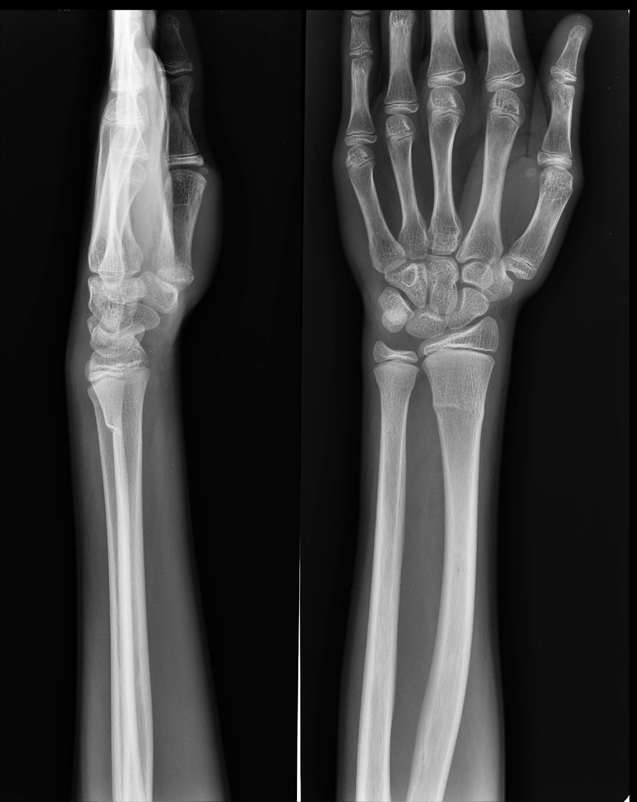 Though He Fall "GreenStick" Submission 24