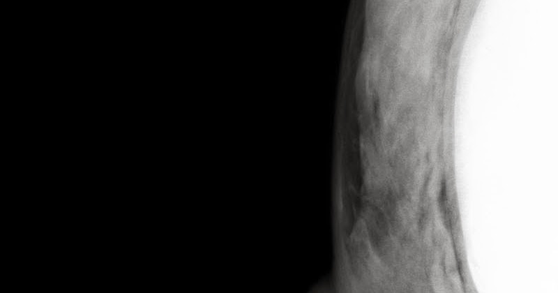 My E Radiology Cases Case 508 40 Year Old Women With Palpable Lump