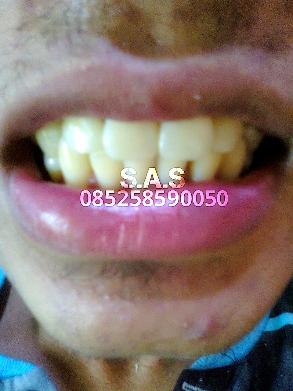 Merapikan Gigi Renggang Dengan Cepat dan Tanpa Behel / Kawat Gigi Versi ...