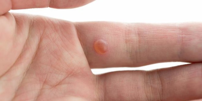  Remedies of wart removal