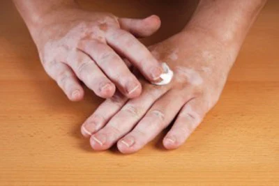Vitiligo y la inflamación cutánea
