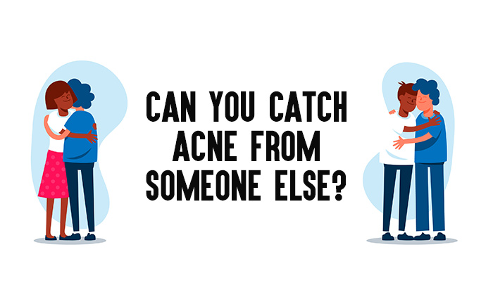 Can You Catch Acne From Someone Else?