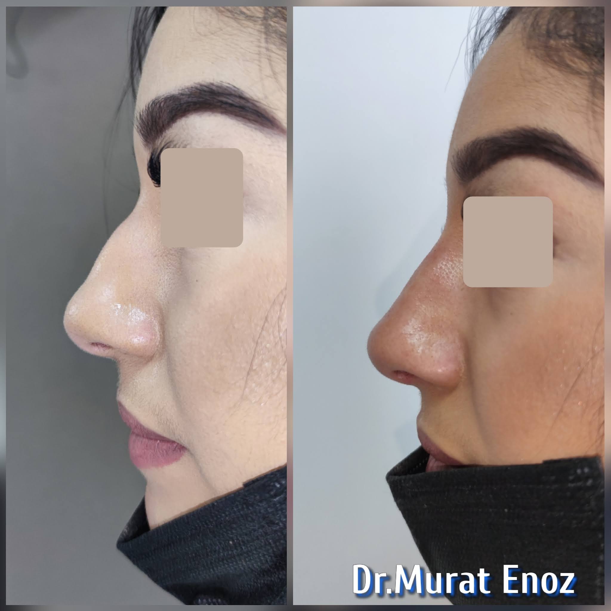 Burun Dolgusu Fiyatı 2022 (Güncellendi!)