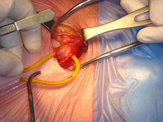 there are two types of surgery for hernia