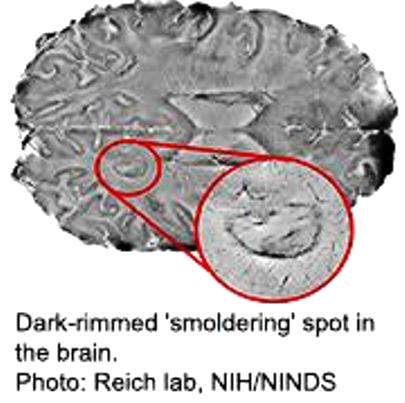 Scans Reveal 'Smoldering' Spots in Brains Touched by MS