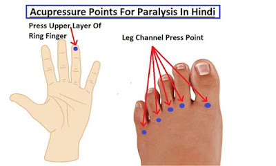 लकवा ठीक कैसे करे, Paralysis Meaning In Hindi, paralysis images, Acupressure Points For Paralysis In Hindi । पक्षाघात के लिए एक्यूप्रेशर अंक